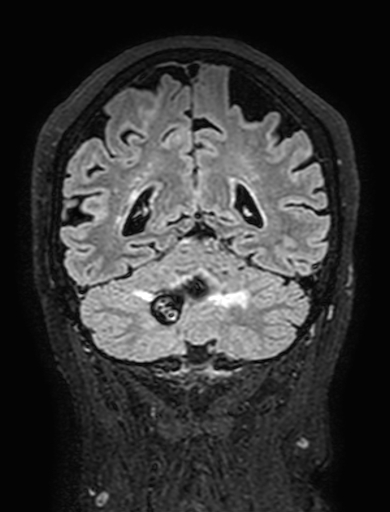 Cavernous hemangioma of the cerebellar falx (Radiopaedia 73025-83724 Coronal FLAIR 256).jpg