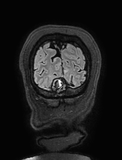 Cavernous hemangioma of the cerebellar falx (Radiopaedia 73025-83724 Coronal FLAIR 330).jpg