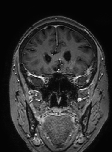 Cavernous hemangioma of the cerebellar falx (Radiopaedia 73025-83724 Coronal T1 C+ 117).jpg