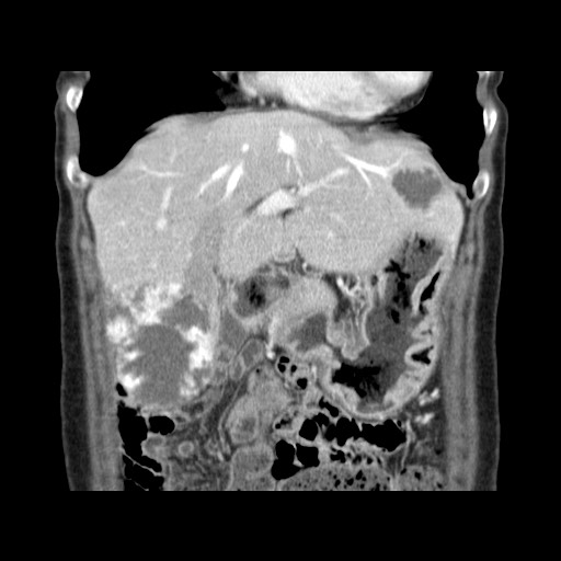 Cavernous hepatic hemangioma (Radiopaedia 75441-86667 C 44).jpg