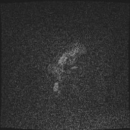 Cavernous sinus meningioma (Radiopaedia 63682-72367 Sagittal T1 C+ 174).jpg