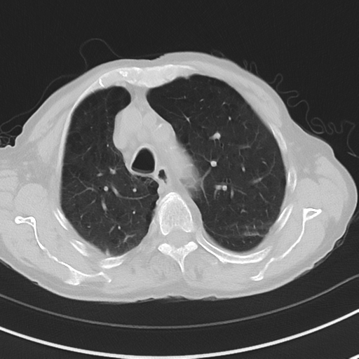 Cavitating pneumonia - lingular segments (Radiopaedia 34386-35678 Axial lung window 18).png
