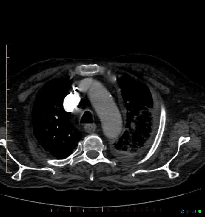 Cavitating pulmonary infarction (Radiopaedia 54634-60849 Axial C+ CTPA 11).jpg