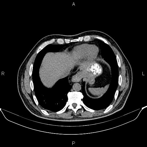 Cecal adenocarcinoma (Radiopaedia 85324-100916 Axial non-contrast 9).jpg