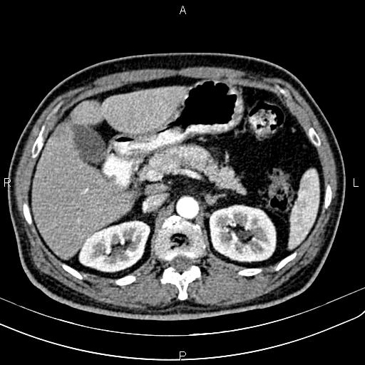 Cecal cancer with appendiceal mucocele (Radiopaedia 91080-108651 A 72).jpg
