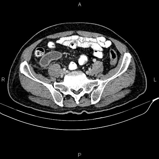 File:Cecal cancer with appendiceal mucocele (Radiopaedia 91080-108651 B 78).jpg