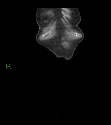 Cecal volvulus (Radiopaedia 86741-102900 B 76).jpg