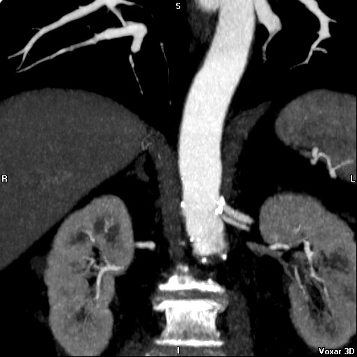 File:Celiac artery anatomy (Radiopaedia 16763-16476 A 16).jpg