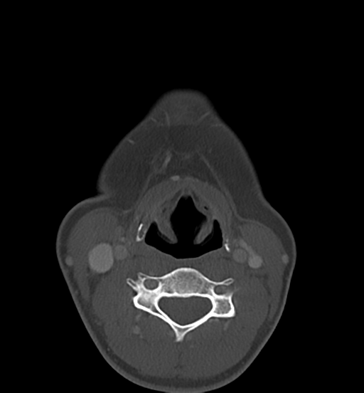 File:Cemento-ossifying fibroma (Radiopaedia 46243-50643 Axial bone window 52).png