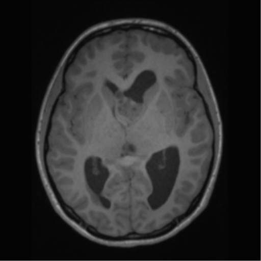 File:Central neurocytoma (Radiopaedia 37664-39557 Axial T1 36).png