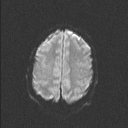 Central neurocytoma (Radiopaedia 56690-63469 Axial DWI 36).jpg