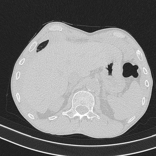 Central venous catheter tip extravasation (Radiopaedia 82828-97113 Axial lung window 79).jpg