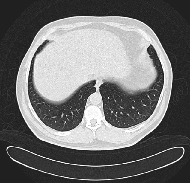 Centrilobular pulmonary emphysema (Radiopaedia 26808-26971 C 37).jpg