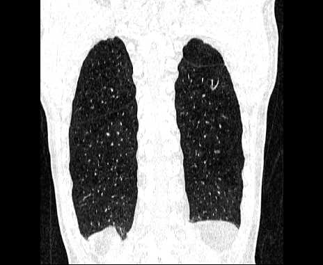 Centrilobular pulmonary emphysema (Radiopaedia 62468-70718 Coronal lung window 62).jpg