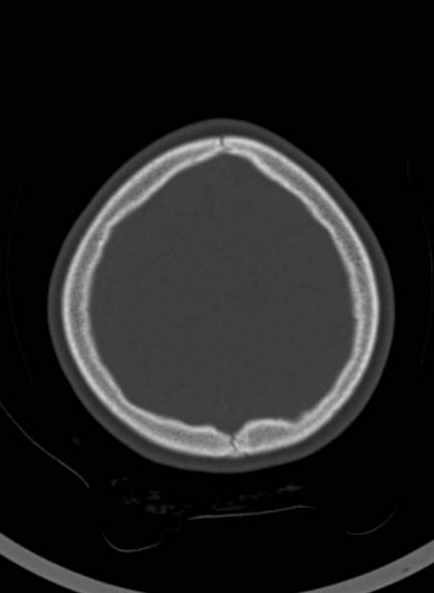 File:Cerebellar abscess (Radiopaedia 73727-84527 Axial bone window 56).jpg
