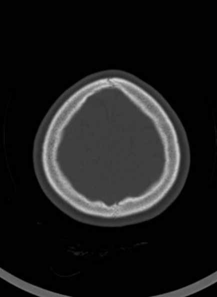 Cerebellar abscess (Radiopaedia 73727-84527 Axial bone window 58).jpg
