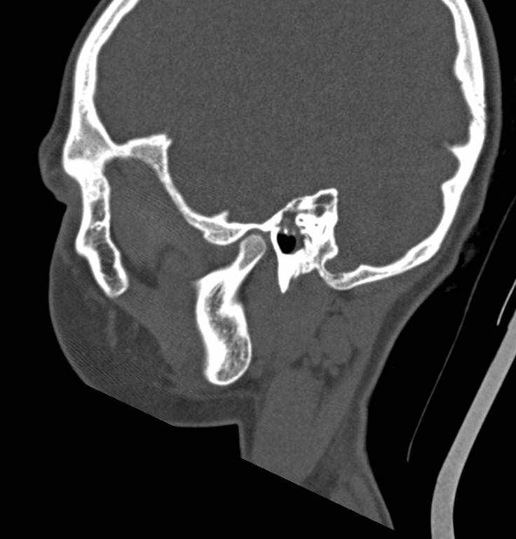 Cerebellar abscess (Radiopaedia 73727-84527 Sagittal bone window 22).jpg