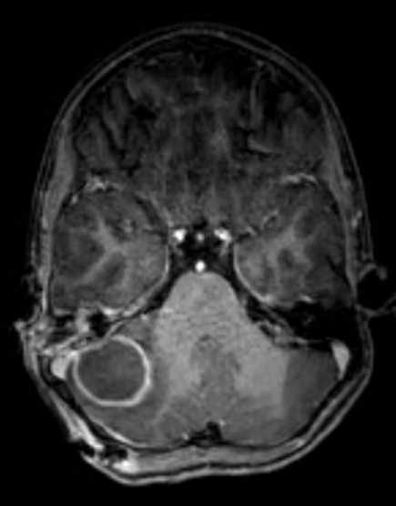 Cerebellar abscess (Radiopaedia 73727-84563 Axial T1 C+ fat sat 47).jpg