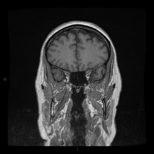 Cerebellar abscess (Radiopaedia 78135-90678 Coronal T1 C+ 46).jpg