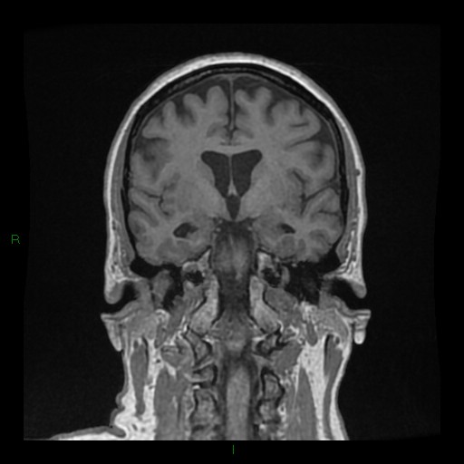 Cerebellar abscess (Radiopaedia 78135-90678 Coronal T1 C+ 77).jpg