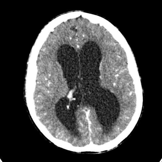 Cerebellar abscess secondary to mastoiditis (Radiopaedia 26284-26412 Axial C+ delayed 89).jpg