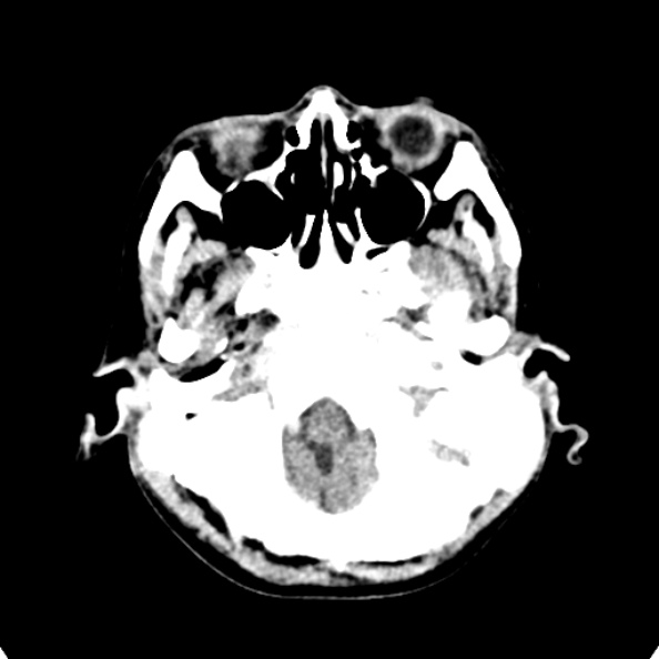 File:Cerebellar abscess secondary to mastoiditis (Radiopaedia 26284-26412 Axial non-contrast 18).jpg