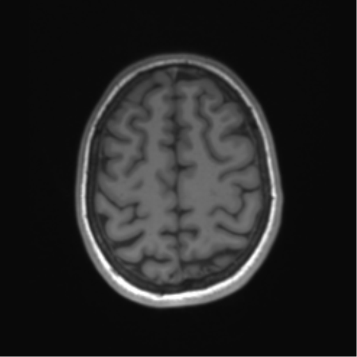 Cerebellar agenesis with hypoplastic pons (pontocerebellar hypoplasia) (Radiopaedia 57224-64138 Axial T1 61).png