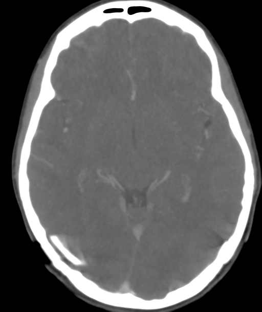 Cerebellar arteriovenous malformation- with hemorrhage (Radiopaedia 35752-37297 B 24).png