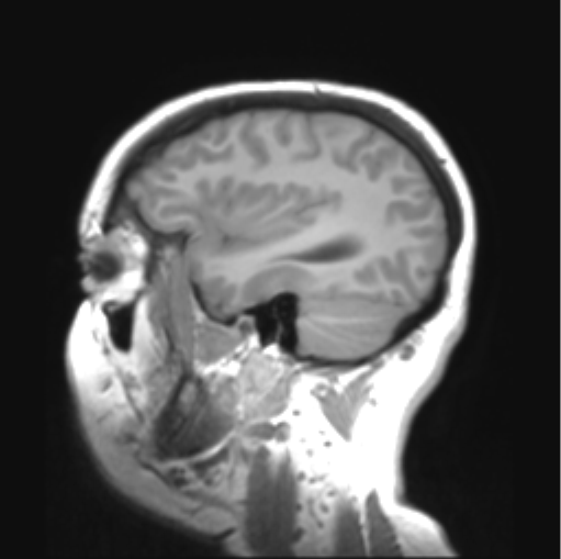 File:Cerebellar ependymoma complicated by post-operative subdural hematoma (Radiopaedia 83322-97736 Sagittal T1 10).png