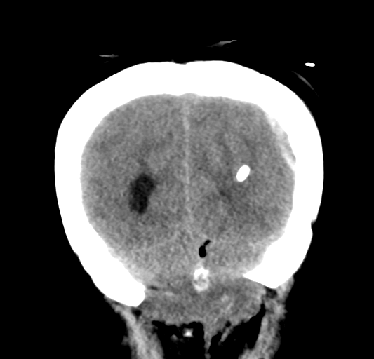 File:Cerebellar ependymoma complicated by post-operative subdural hematoma (Radiopaedia 83322-97737 Coronal non-contrast 33).png