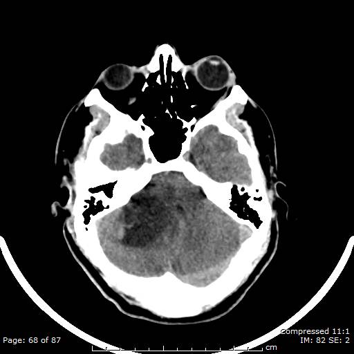 Cerebellar hemangioblastoma (Radiopaedia 52360-58258 Axial non-contrast 68).jpg