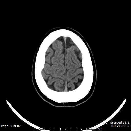 Cerebellar hemangioblastoma (Radiopaedia 52360-58258 Axial non-contrast 7).jpg