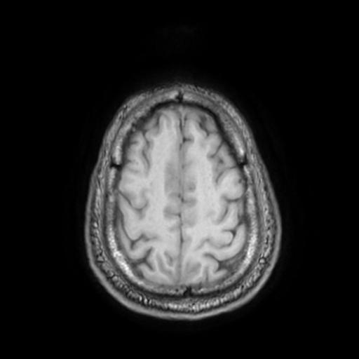 File:Cerebellar hemangioblastoma (Radiopaedia 88055-104622 Axial T1 29).jpg