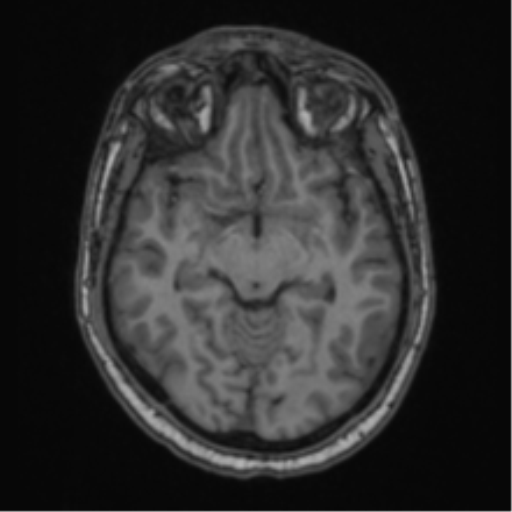 Cerebellar hemangioblastomas and pituitary adenoma (Radiopaedia 85490-101176 Axial T1 32).png