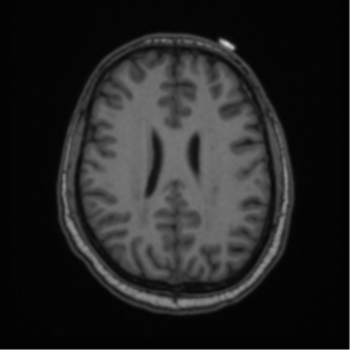 Cerebellar hemangioblastomas and pituitary adenoma (Radiopaedia 85490-101176 Axial T1 48).png