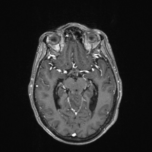 Cerebellar metastases (Radiopaedia 24038-24249 Axial T1 C+ 21).jpg