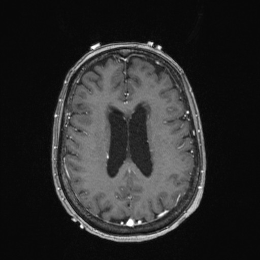 Cerebellar metastases (Radiopaedia 24038-24249 Axial T1 C+ 4).jpg