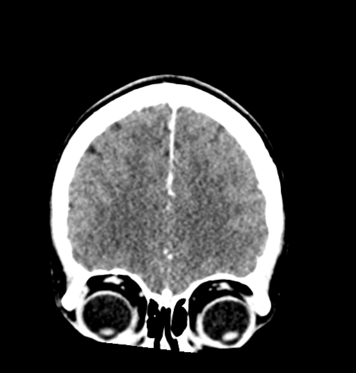 Cerebellar metastases - colorectal adenocarcinoma (Radiopaedia 40947-43652 Coronal C+ 24).png