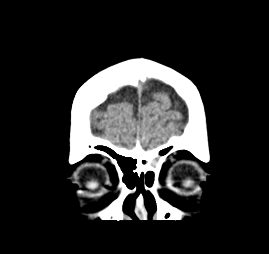 Cerebellar metastasis (Radiopaedia 54578-60812 Coronal non-contrast 5).png