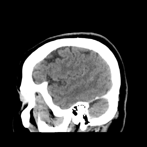 Cerebellar metastasis (cystic appearance) (Radiopaedia 41395-44258 F 12).png