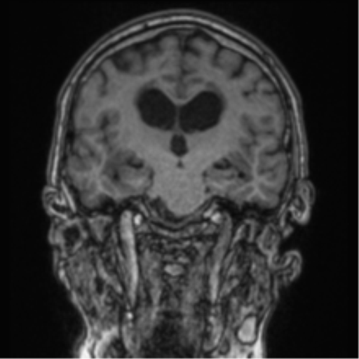 Cerebellar metastasis from lung adenocarcinoma (Radiopaedia 86690-102829 Coronal T1 52).png