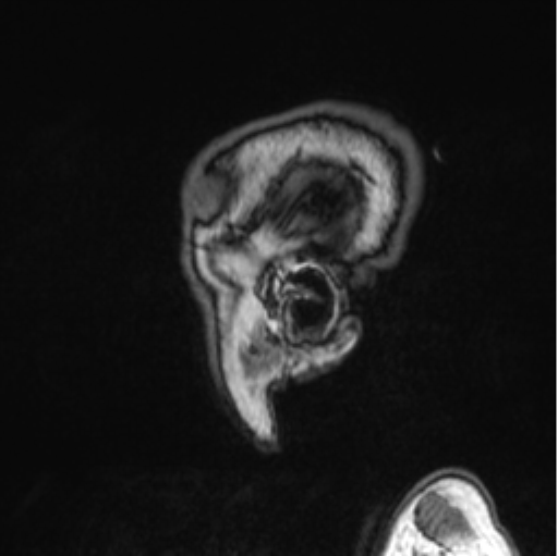 Cerebellar metastasis from lung adenocarcinoma (Radiopaedia 86690-102829 Sagittal T1 87).png