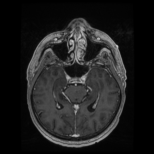 Cerebellar metastasis of pulmonary adenocarcinoma, cavernous venous malformation, and developmental venous anomaly (Radiopaedia 85827-101661 Axial T1 C+ 43).jpg