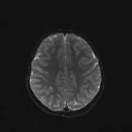 File:Cerebellar stroke (Radiopaedia 32202-33150 Axial DWI 17).png