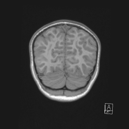 File:Cerebellar stroke (Radiopaedia 32202-33150 Coronal T1 51).png