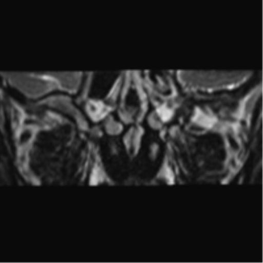 File:Cerebellopontine angle meningioma (Radiopaedia 48434-53348 Coronal T2 90).png