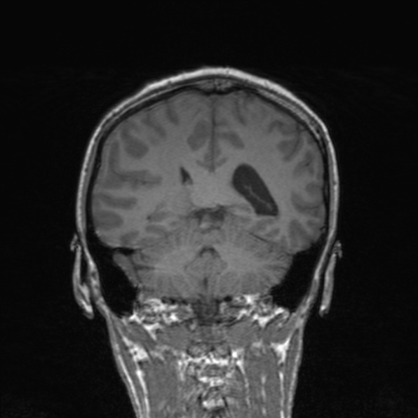Cerebral abscess (Radiopaedia 24212-24478 Coronal T1 138).jpg