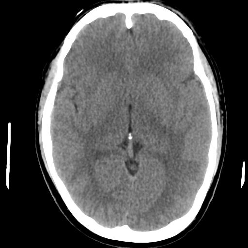 Cerebral abscess (Radiopaedia 29451-29919 Axial non-contrast 24).jpg