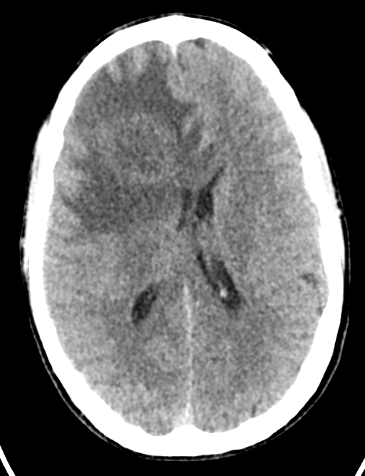 Cerebral abscess (Radiopaedia 60342-68008 Axial non-contrast 31).png