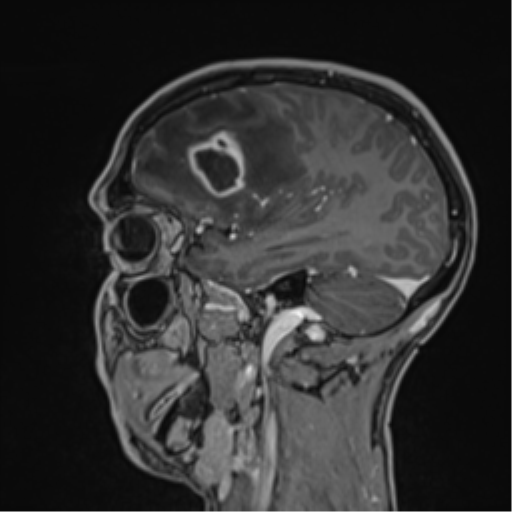 Cerebral abscess (Radiopaedia 60342-68009 J 41).png